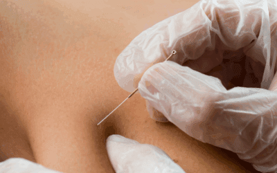 Dry Needling Explained: What to Expect and How It Supports Faster Recovery