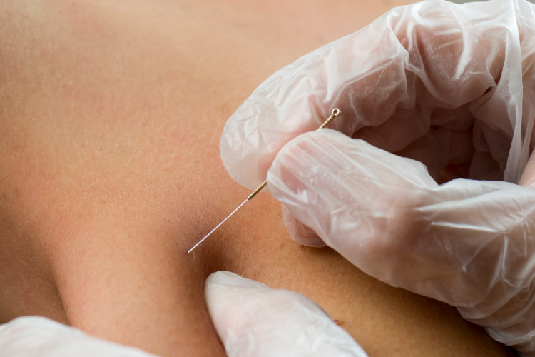 Dry needling therapy targeting muscle pain for faster recovery
