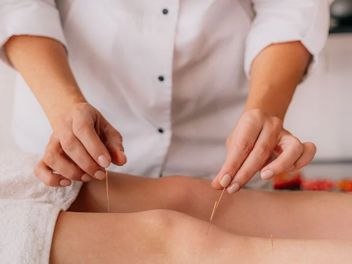 Acupuncture treatment with needles on person's leg